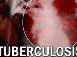 81.753 Pasien TBC Pada Tahun 2022, Jatim Tertinggi No 2 Nasional